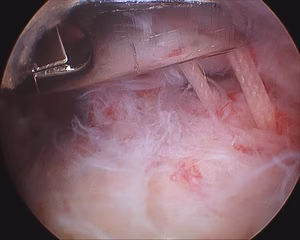 Shoulder PASTA Repair Sutures in Subacromial Space