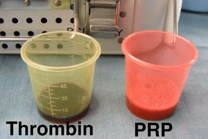 PRP 7