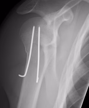 Paediatric Shoulder K wire Lateral