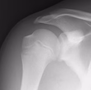 Paediatric Shoulder Post MUA
