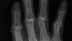 Rheumatoid Arthritis PIPJ OA
