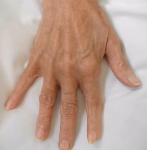 Rheumatoid Boutonniere Finger