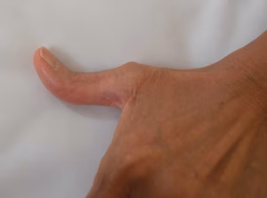Rheumatoid thumb Boutonneire