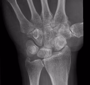 SLAC Wrist