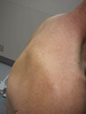 SS IS Clinical Photo 2