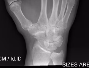 STT Arthritis 2