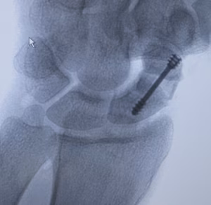 Scaphoid BG ORIF 2