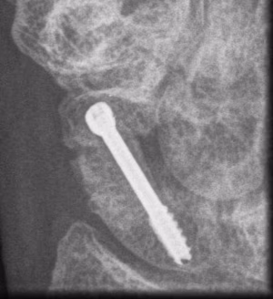 Scaphoid Nonunion Iliac crest Bone Graft