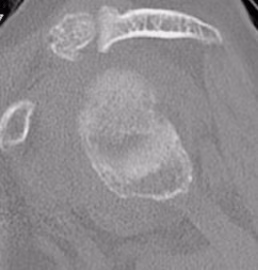 Shoulder CT Glenoid Oval