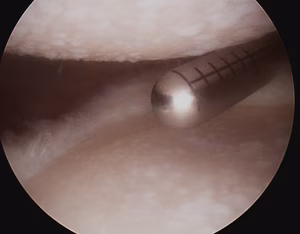 Shoulder OA Debridement