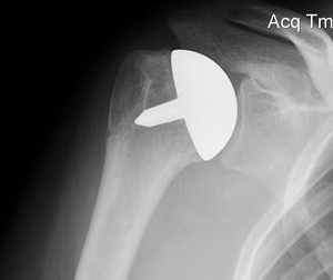 Shoulder Resurfacing
