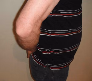 Subscapularis Lift Off Test 1