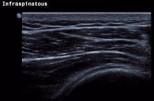 Shoulder Ultrasound Infraspinatous Normal