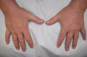 Wasting Adductor Pollicis Right Hand
