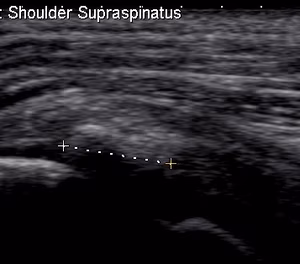 Ultrasound Calcific Tendonitis