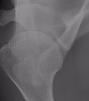 Os Acominale Xray