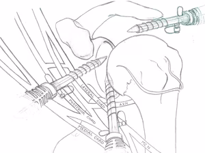 Shoulder Portals Labral Repair