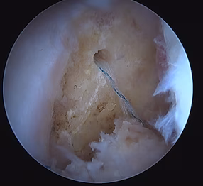 Acute PCL femoral Peel off