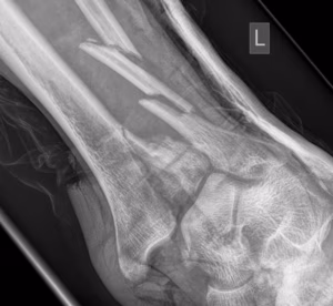 Fibular fracture tibial plafond