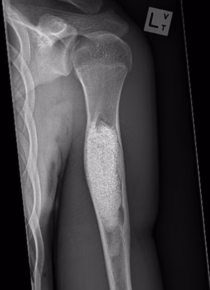 Bone substitute UBC