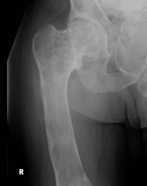 Fibrous dysplasia hip