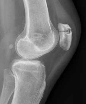 Fracture
