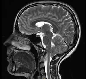 Chiari malformation