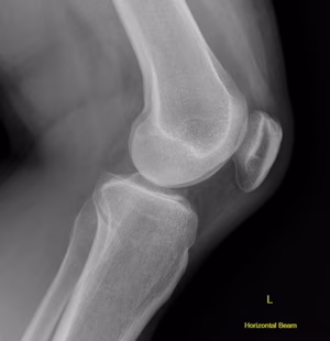 Posterior tibial subluxation xray