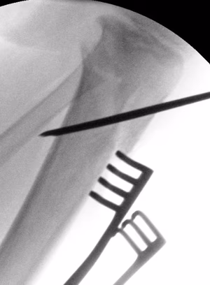 Blounts osteotomy