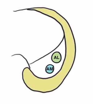 PCL femoral tunnels