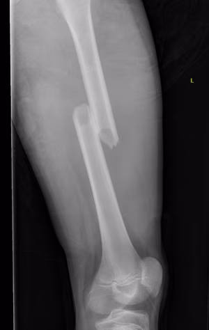 Femur