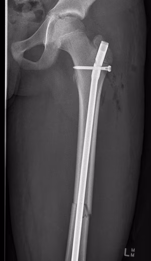 Femur
