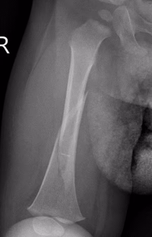 1 month femur