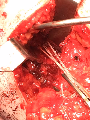 post shoulder