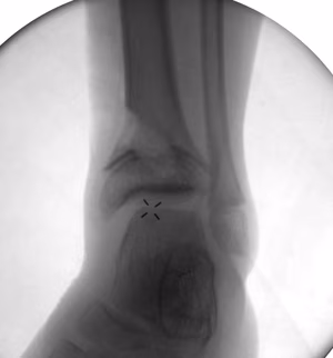 Epiphysiolysis