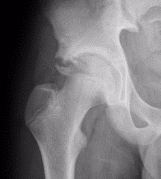 AIIS avulsion 3