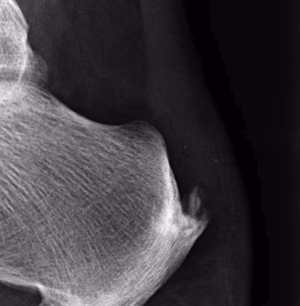 Achilles calcification
