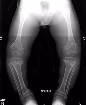 achondroplasia