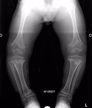 achondroplasia
