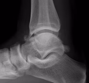 Anterior ankle spur