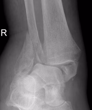 Fragility fracture