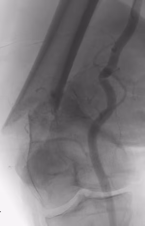 RCC femur 1