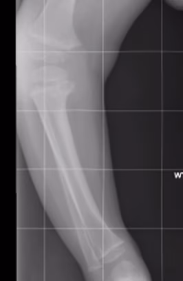Blounts osteotomy
