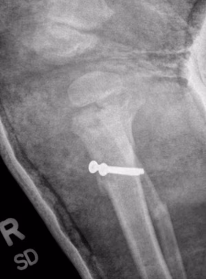Blounts osteotomy
