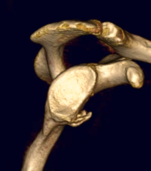 bony bankart