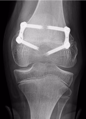 CP knee
