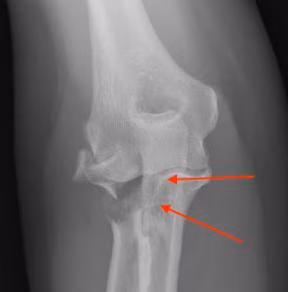 Lesser sigmoid notch