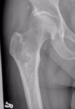 CS hip 1