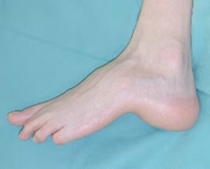 calcaneocavus