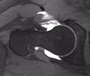 Capsular deficiency